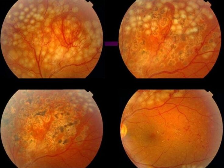 Retinopathie door hypertensie